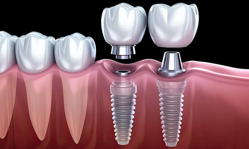Ahmedabad, Dental, Replace Missing Teeth With Dental Implants | The Dental Wellness Centre