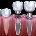 Replace Missing Teeth With Dental Implants | The Dental Wellness Centre