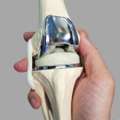 Knee Replacement In East Delhi