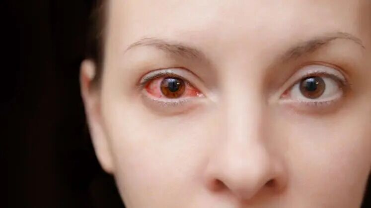 Faridabad, Health, Eye Disease Treatment In Faridabad At Eyeroots