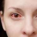 Eye Disease Treatment In Faridabad At Eyeroots