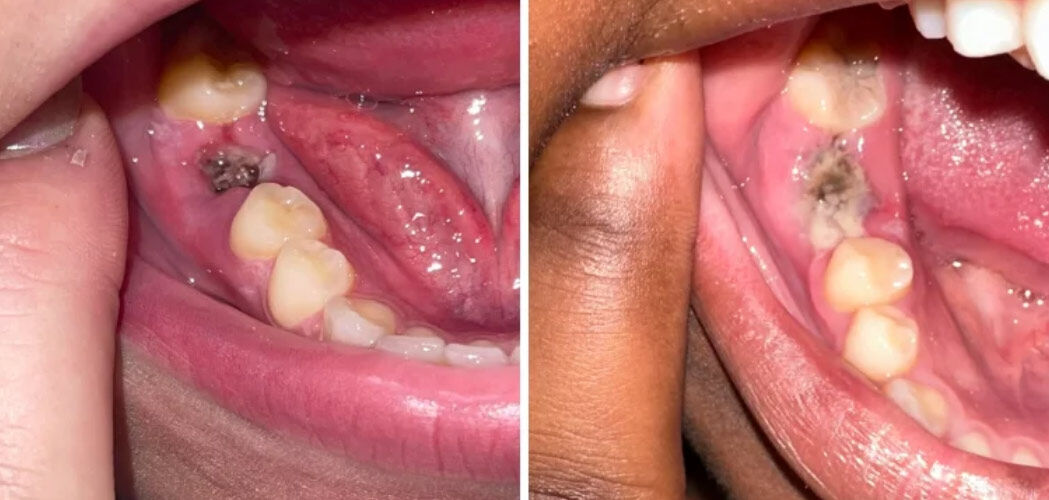 New York, Dental, How To Prevent Dry Socket After A Tooth Extraction?