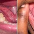 How To Prevent Dry Socket After A Tooth Extraction?