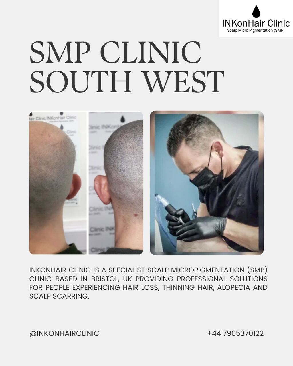 London, Business, SMP Clinic South West | Natural Scalp Micropigmentation