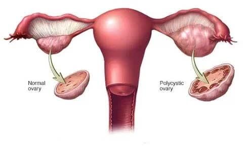 New Delhi, Health, PCOS & PCOD Treatment In Delhi