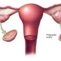 PCOS & PCOD Treatment In Delhi