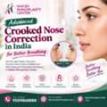 Advanced Crooked Nose Correction In India For Better Breathing