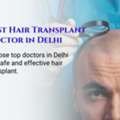 What To Expect When Consulting A Hair Transplant Surgeon In Delhi