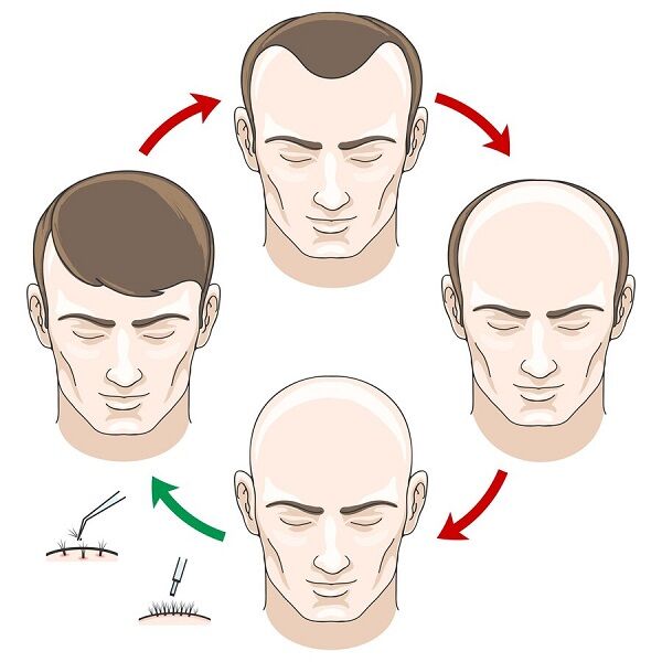 London, Beautician, Hair Transplant Leeds: Start Your Journey To Fuller Hair