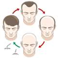 Hair Transplant Leeds: Start Your Journey To Fuller Hair