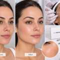 Hair Loss Clinic London & Pigmentation Treatment London &ndash; Abes Aesthetics