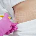 Fat Dissolving Injections On Stomach &ndash; Non-Surgical Body Contouring