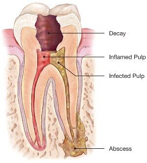 Mumbai, Dental, Affordable Root Canal Treatment Near Me For Lasting Care