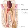 Affordable Root Canal Treatment Near Me For Lasting Care