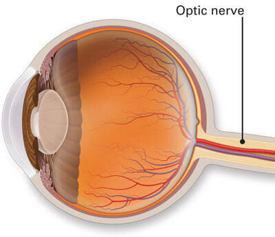 New Delhi, Health, Looking For Optic Nerve Atrophy Care In Delhi? Consult An Eye Specialist Today