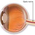 Looking For Optic Nerve Atrophy Care In Delhi? Consult An Eye Specialist Today