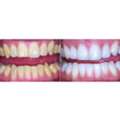 Dental Cleaning Orangeville