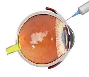 New Delhi, Health, Need Macular Degeneration Treatment In Delhi? Book An Eye Consultation Today