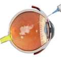 Need Macular Degeneration Treatment In Delhi? Book An Eye Consultation Today