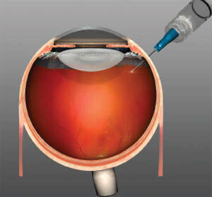 New Delhi, Health, Seeking Macular Degeneration Treatment In Delhi? Contact An Eye Specialist Today