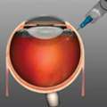 Seeking Macular Degeneration Treatment In Delhi? Contact An Eye Specialist Today