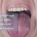 What Is A Scalloped Tongue And What Could Be Causing It?
