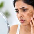 Dark Patches On Face – Causes And Treatment
