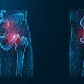 Total Hip Replacement Surgery Albury | Hip Joint Treatment