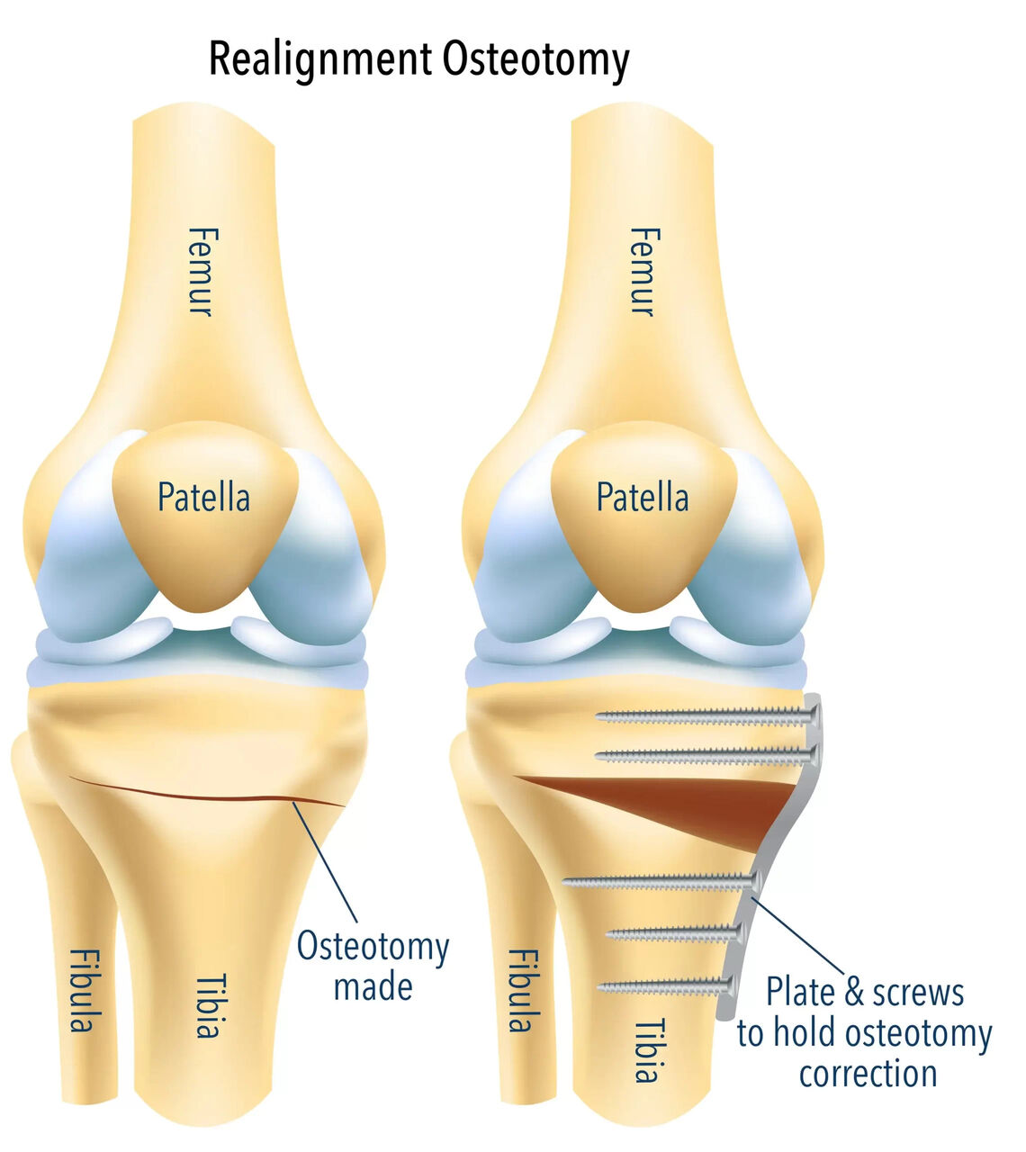 Melbourne, Health, Protect Your Knee With Osteotomy Surgery