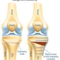 Protect Your Knee With Osteotomy Surgery