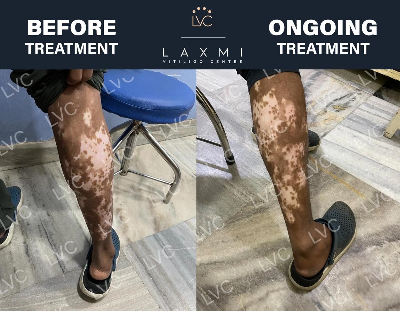 Madurai, Health, Homeopathic Vitiligo Treatment In Madurai | Laxmi Vitiligo Centre