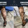 Homeopathic Vitiligo Treatment In Madurai | Laxmi Vitiligo Centre