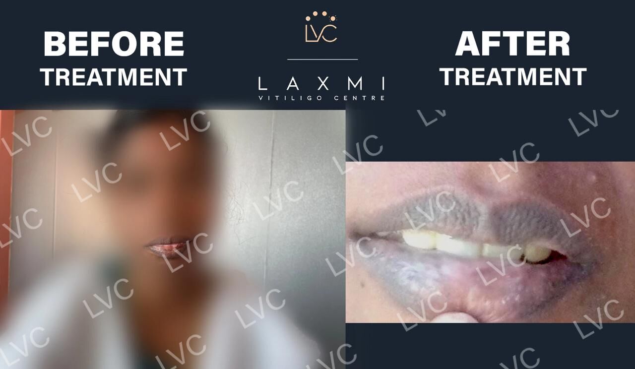 Madurai, Health, Homeopathic Vitiligo Treatment In Madurai | Laxmi Vitiligo Centre