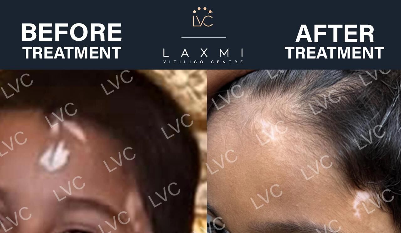 Madurai, Health, Homeopathic Vitiligo Treatment In Madurai | Laxmi Vitiligo Centre