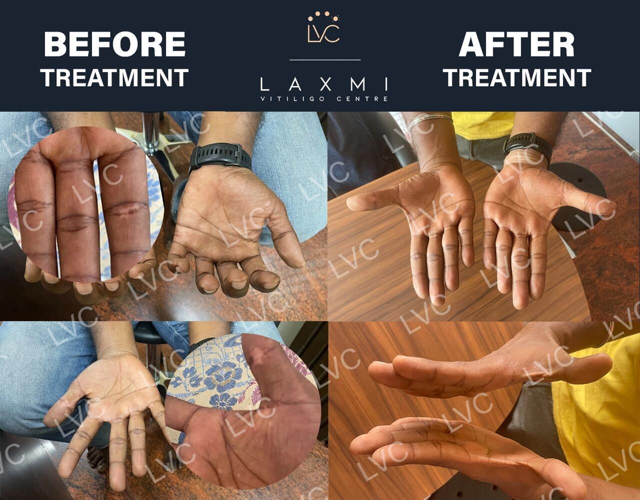Madurai, Health, Homeopathic Vitiligo Treatment In Madurai | Laxmi Vitiligo Centre