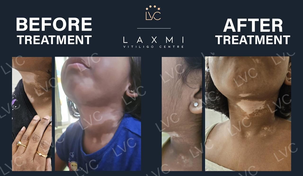 Madurai, Health, Homeopathic Vitiligo Treatment In Madurai | Laxmi Vitiligo Centre