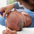Hair Transplant In Noida For Men And Women