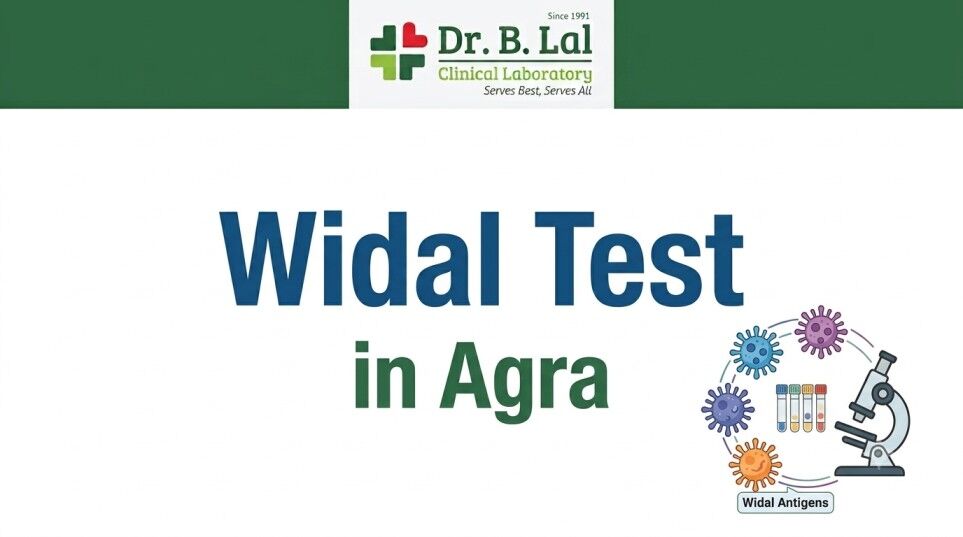 Lucknow, Health & Beauty Items, INR 250,  Widal Test For Fever Diagnosis In Agra | ₹250 With Home Collection