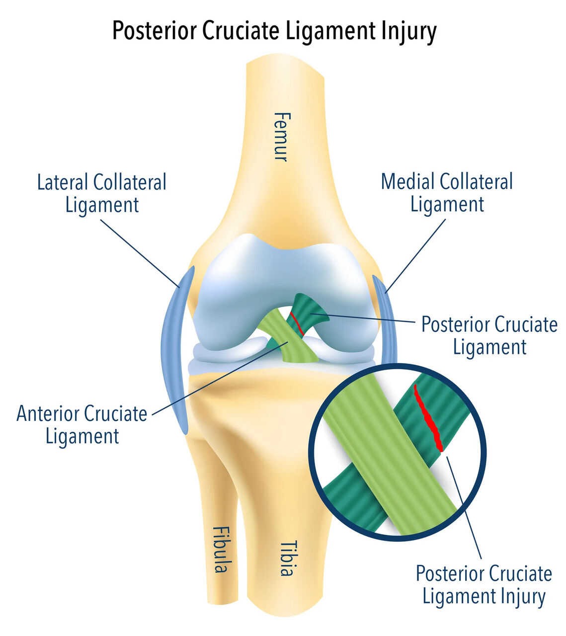 Melbourne, Health, Protect Your Knee From A Posterior Cruciate Ligament Injury