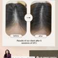 Hair GFC Treatment In Vizag - Derma One Clinic