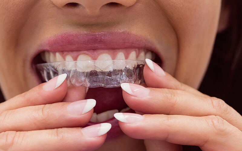 Kerala, Dental, Understanding Teeth Grinding And The Importance Of Professional Dental Care