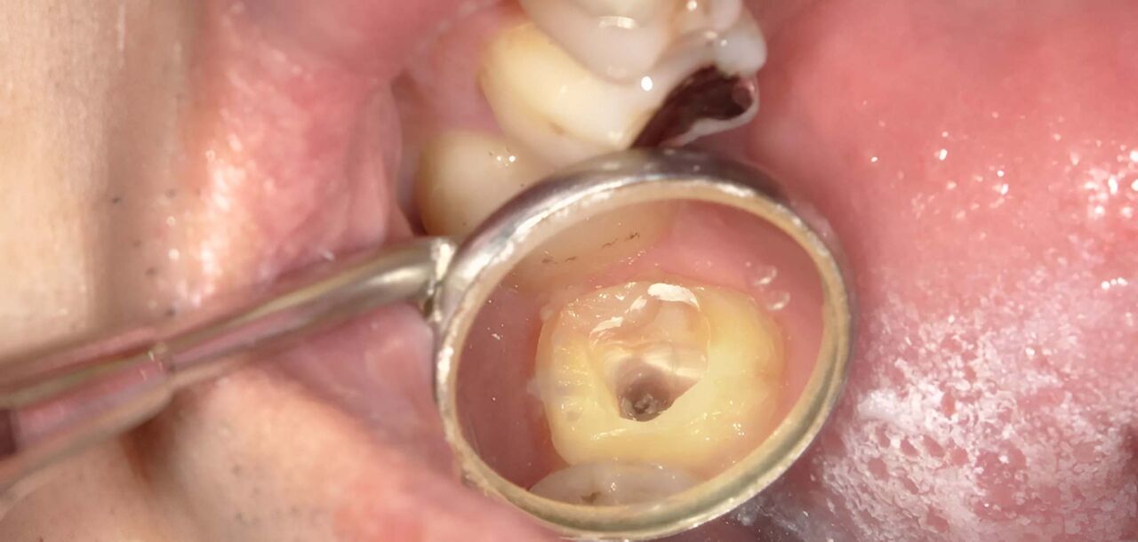 New York, Dental, Cracked Tooth Root: Causes, Symptoms, Diagnosis & Treatment