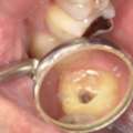 Cracked Tooth Root: Causes, Symptoms, Diagnosis & Treatment