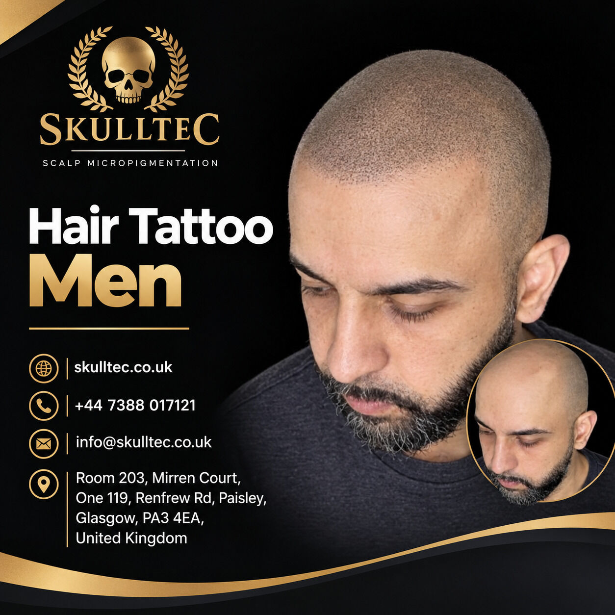 London, Health, Natural-Looking Hair Tattoo For Men | Skulltec Scalp Micropigmentation