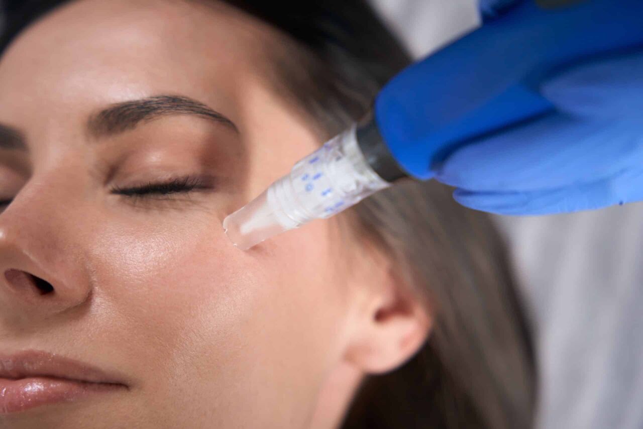 Gurgaon, Health, Microneedling Treatment In Gurgaon &ndash; Get Smooth, Healthy Skin