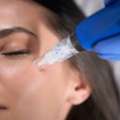 Microneedling Treatment In Gurgaon &ndash; Get Smooth, Healthy Skin