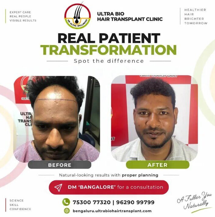 Bangalore, Health, Hair Transplant Packages Bangalore