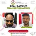Hair Transplant Packages Bangalore