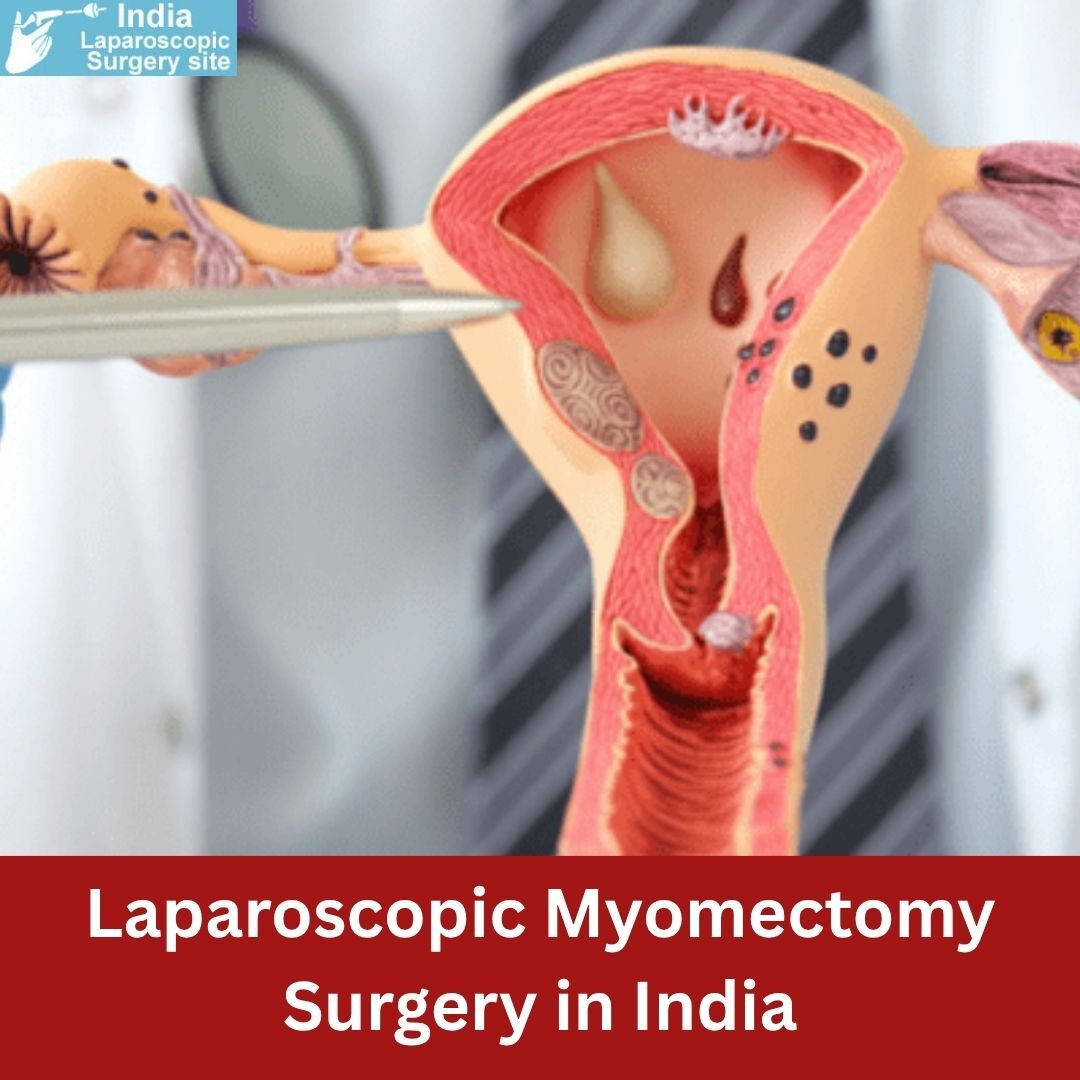 Mumbai, Health, Robotic Myomectomy Surgery Cost In India