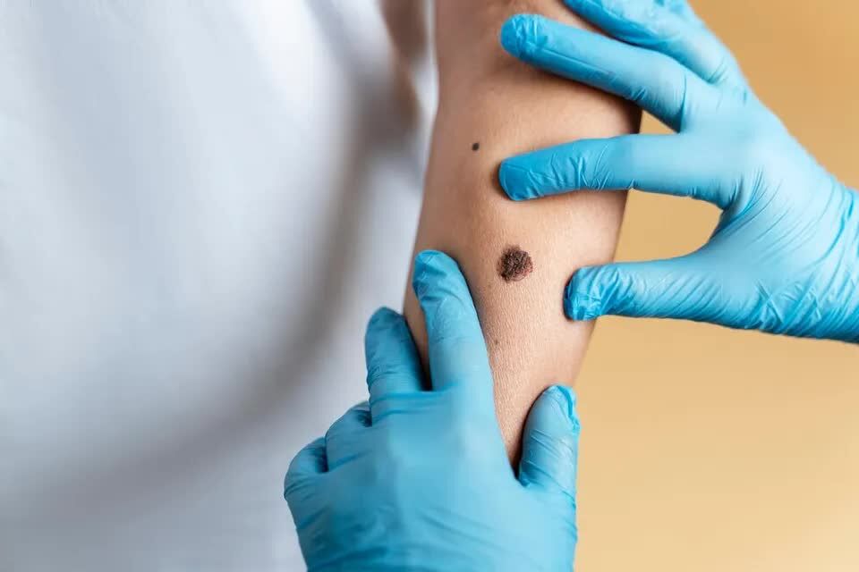 Ahmedabad, Health, Choose A Skin Cancer Oncologist For Expert Lump And Bump Care